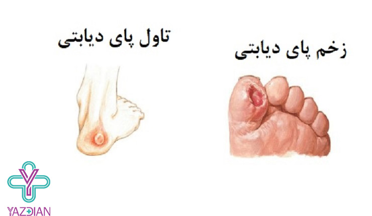 دلایل ایجاد تاول پا چیست